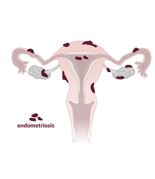 Endometriosis