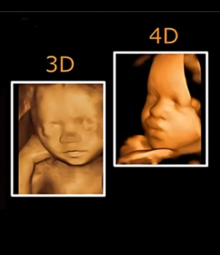 3D & 4D Ultrasound