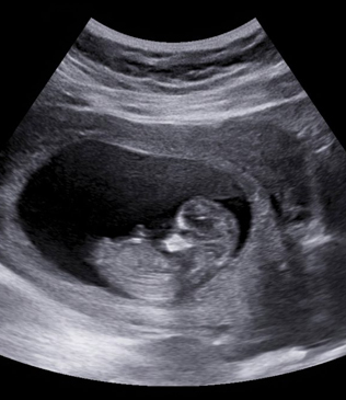 Obstetric Ultrasound