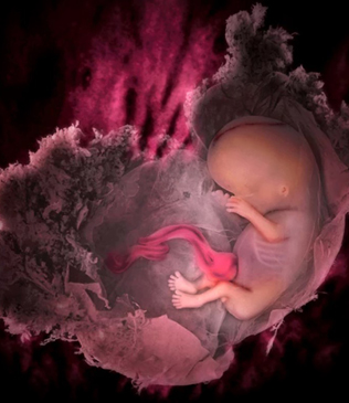 Repeated Miscarriages